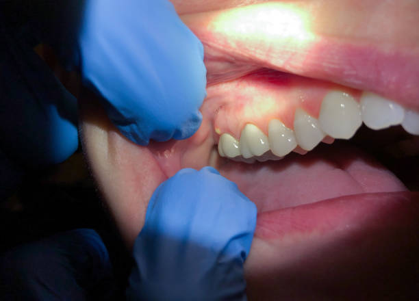 Best Emergency Wisdom Tooth Extraction in Saint Davids, PA